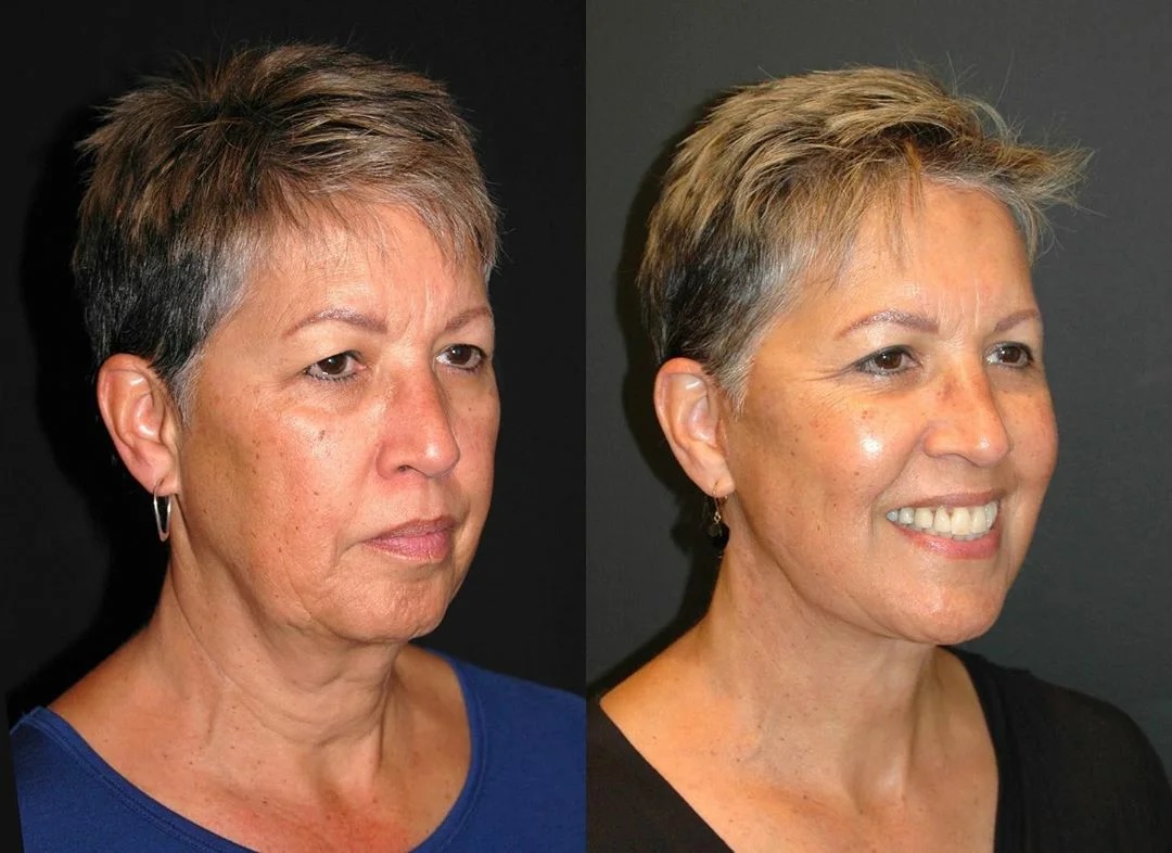 Шея после 40 лет. Пластическая операция подтяжка лица. Лицо в 50 лет без пластики. Как выглядит женщина в 50 лет без пластики. Подтяжка лица до и после.