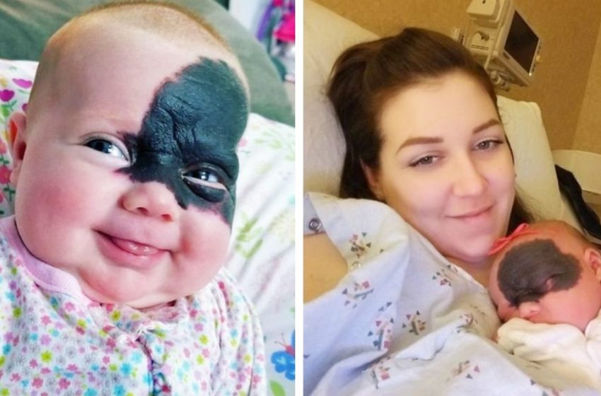  «Малышка – Бэтмен»: как сегодня выглядит девочка из США, которая родилась с родимым пятном на лице
