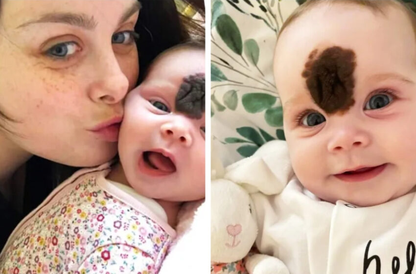  Малышка родилась с большим родимым пятном на лице: Она была прооперирована и выглядит потрясающе после операции