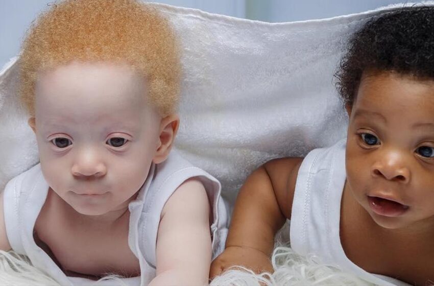  «Их рождение стало для всех большим сюрпризом»: Как сейчас выглядят братья-близнецы с разным цветом кожи?