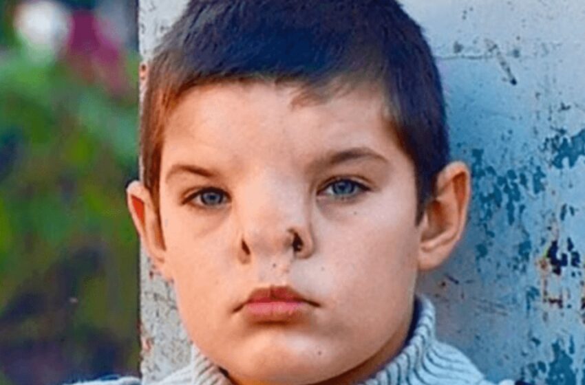  Мальчик, родившийся с редким заболеванием носа, перенес операцию: Как он выглядит теперь?