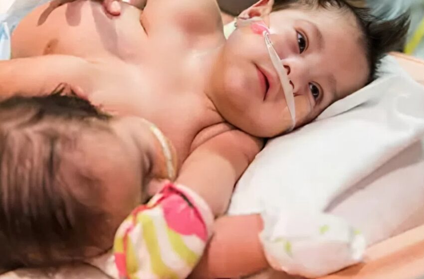  История сиамских близнецов, которые победили все трудности: как Натали и Аделина живут сейчас?