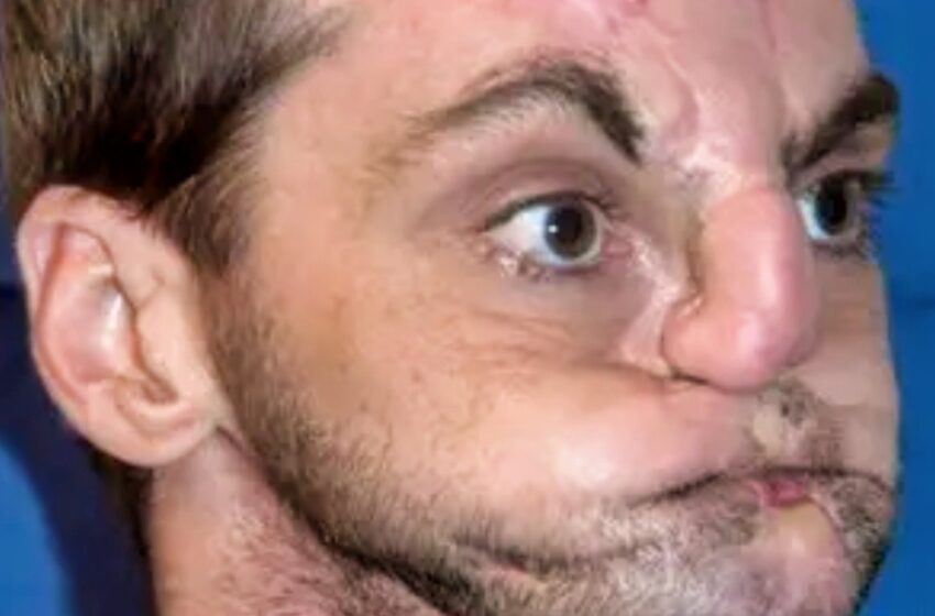  Человек без лица, которому вернули новую жизнь: невероятное преображение Ричарда Норриса потрясло мир